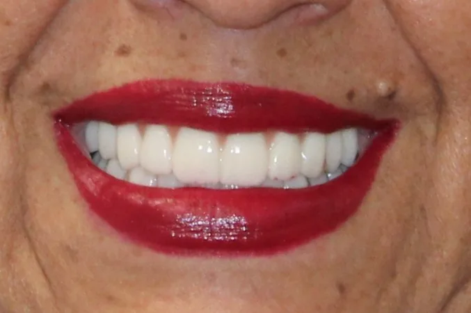 dental implants austin texas