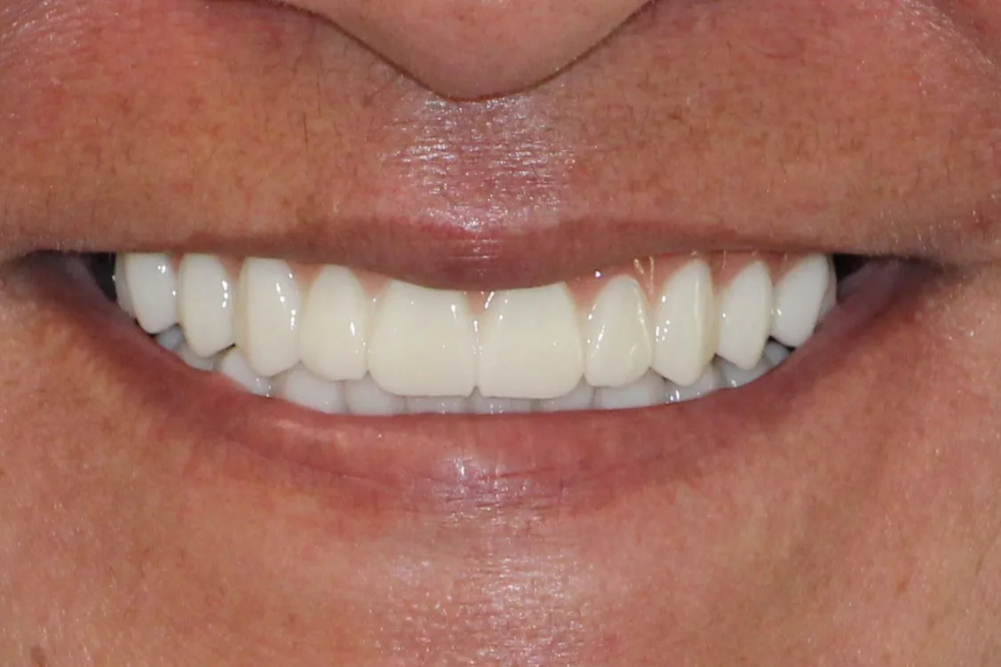 dental implants austin texas