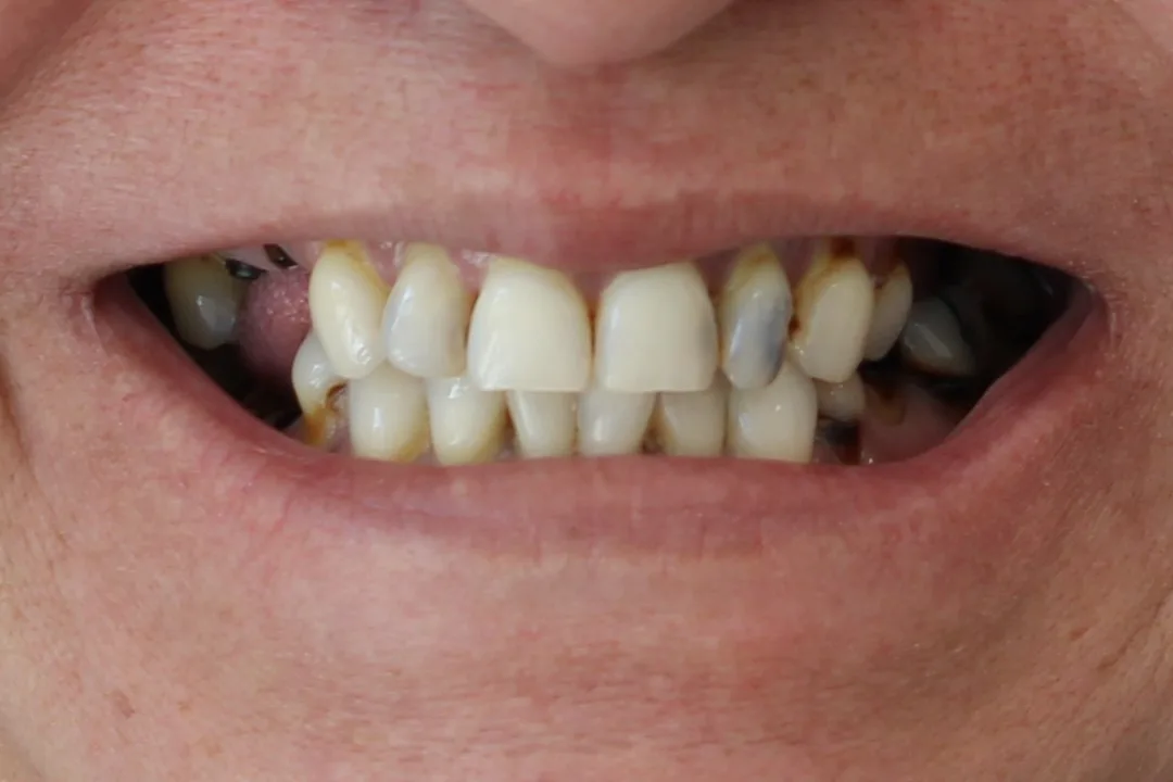 dental implants austin texas