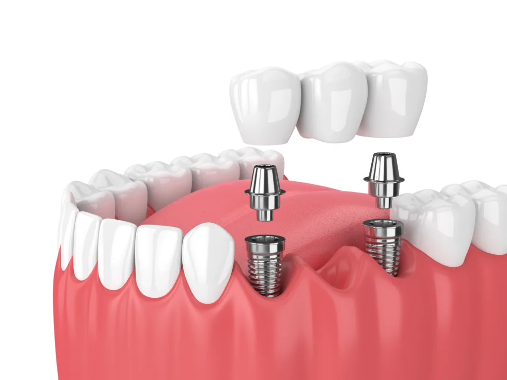 multiple tooth dental implants round rock tx