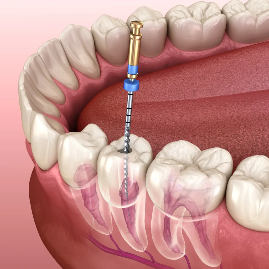 root canal round rock texas