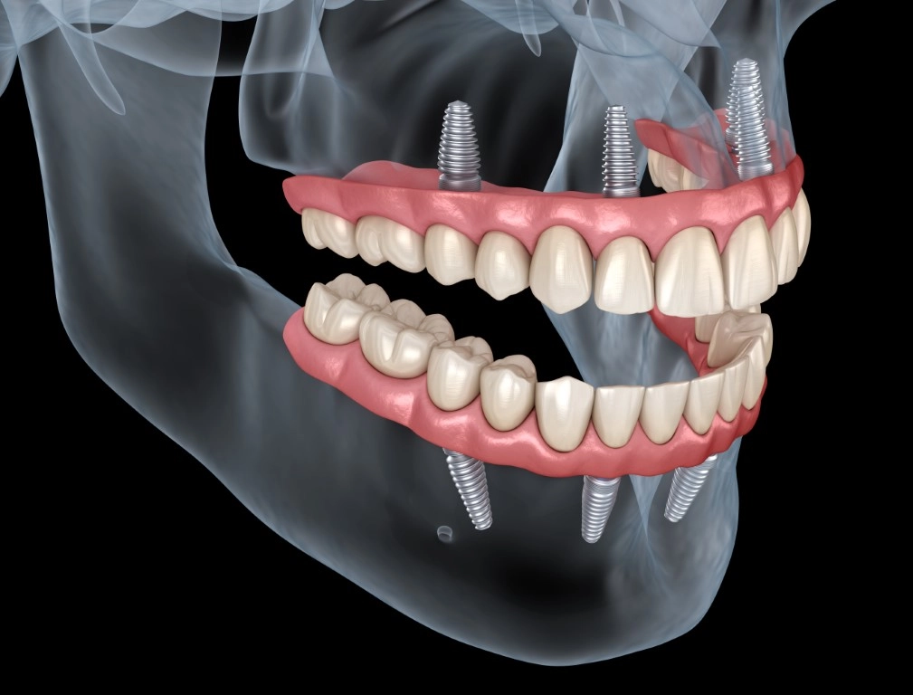 Sinus Augmentation: An Innovative Solution for Bone Loss