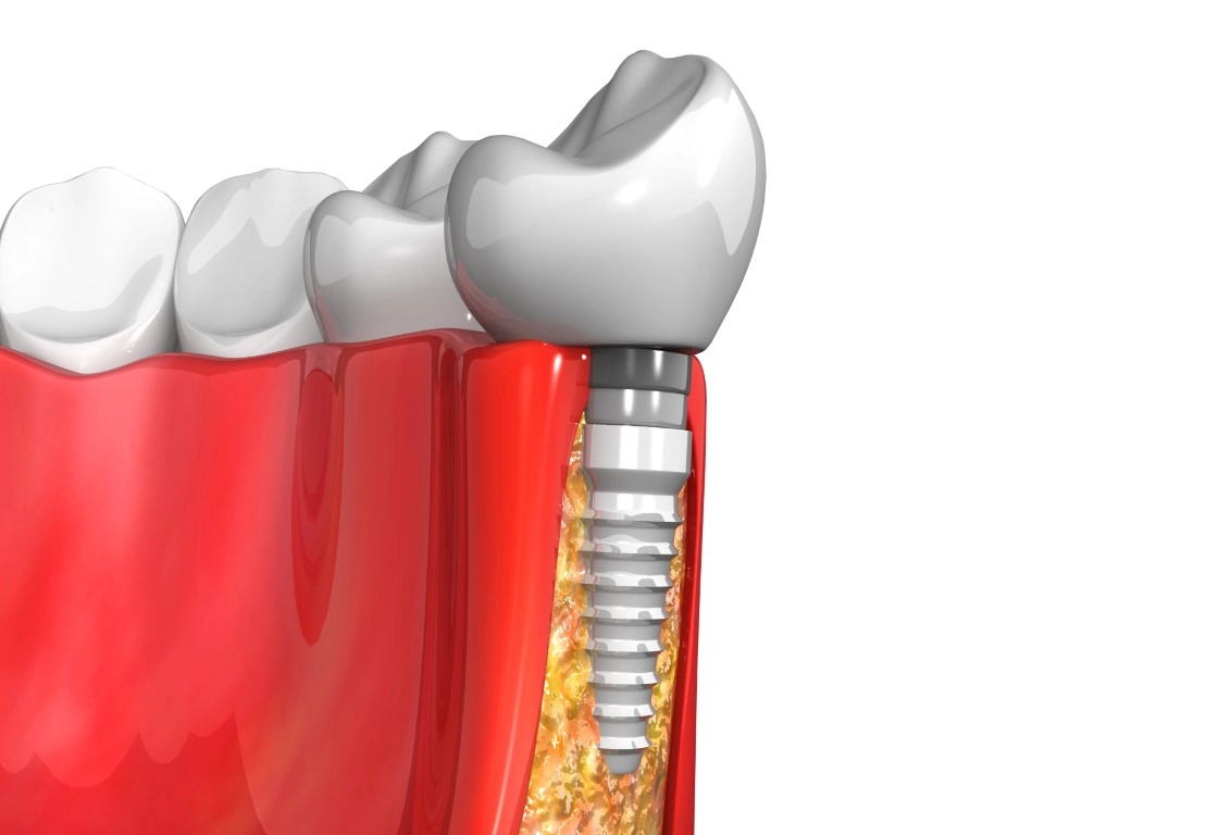 Dental Implant Failure