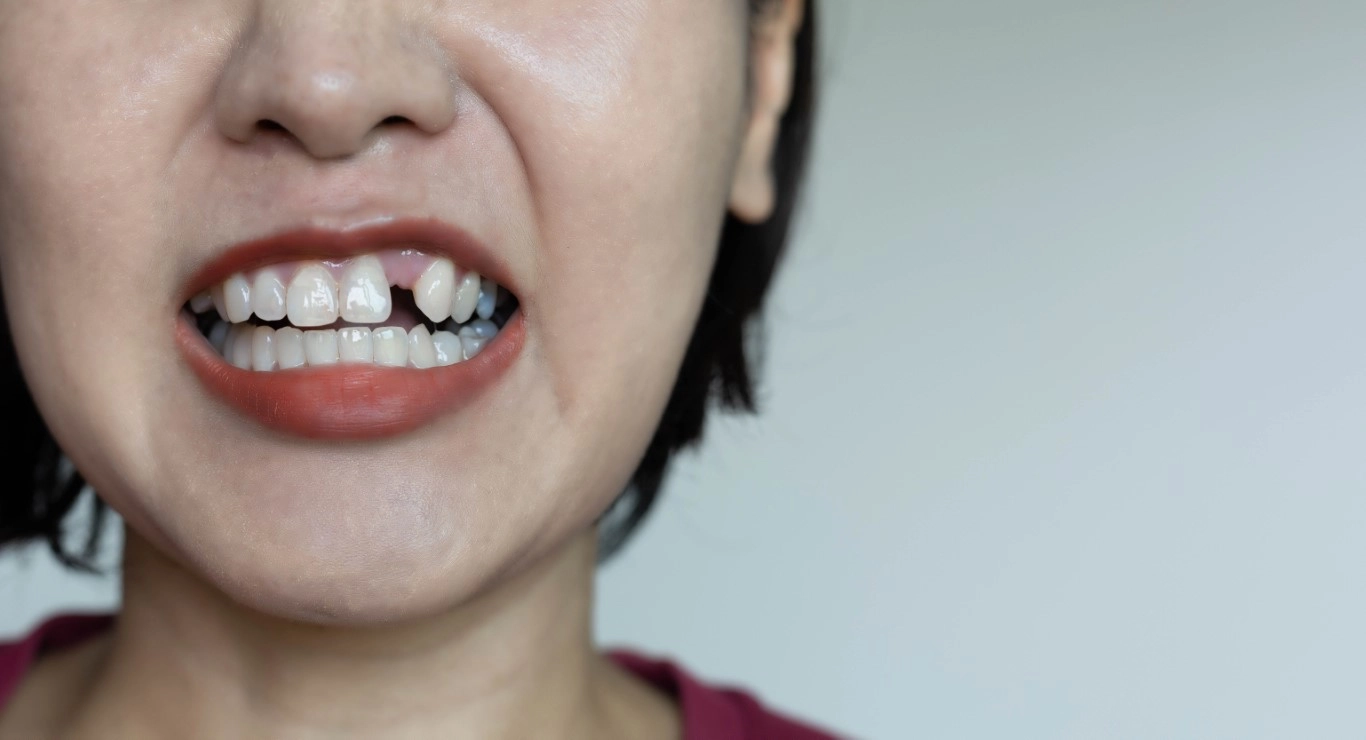 What to Do if Your Tooth Gets Knocked Out
